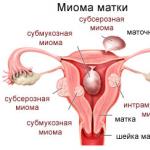 자궁 근종 - 그것이 무엇이며 위험합니까?